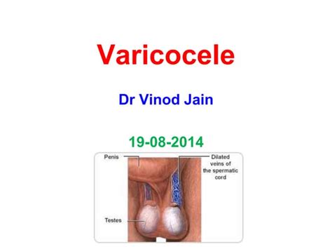 Varicocele Ppt