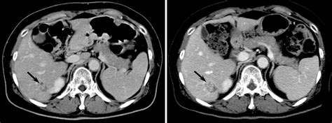 Figure 1 From Imaging Findings Of Intrahepatic Bile Duct Adenoma