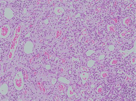 Photomicrograph Of The Granuloma Gravidarum Showing Granulation Tissue Download Scientific