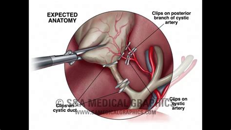 Laparoscopic Cholecystectomy Anatomy