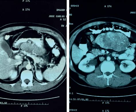 SciELO Brasil Primary Cutaneous Amelanotic Melanoma And