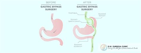 Laparoscopic Roux En Y Gastric Bypass G And L Surgical Clinic