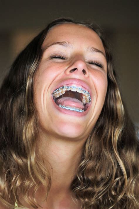 Pin By John Beeson On Girls In Braces Braces Girls Dental Braces