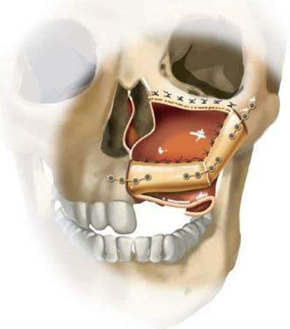 The Hemimaxillectomy Defect Reconstruction With The Fibula