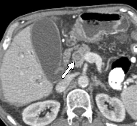 Abnormalities Of The Distal Common Bile Duct And Ampulla Diagnostic