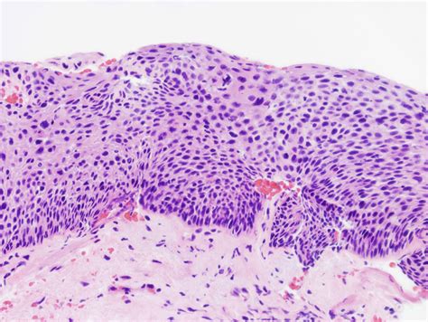 Squamous Cell Carcinoma In Situ Histology