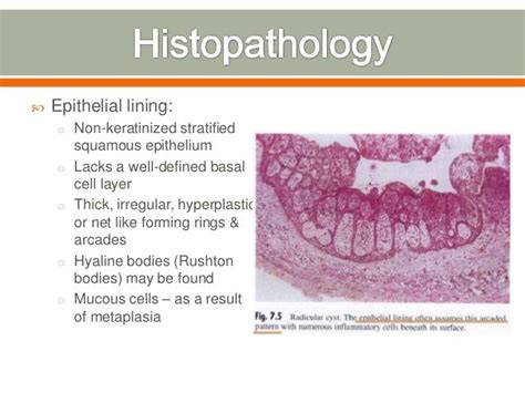Radicular Cyst