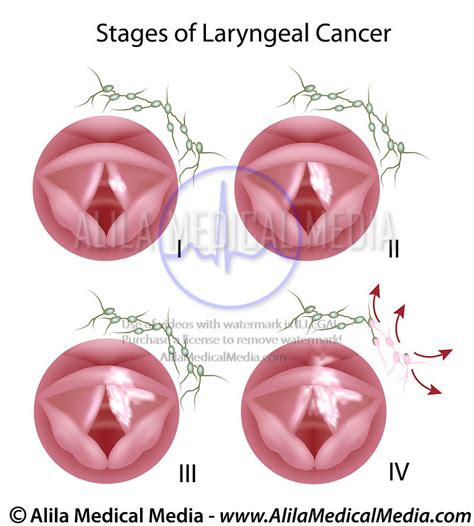 Alila Medical Media Larynx Cancer Medical Illustration