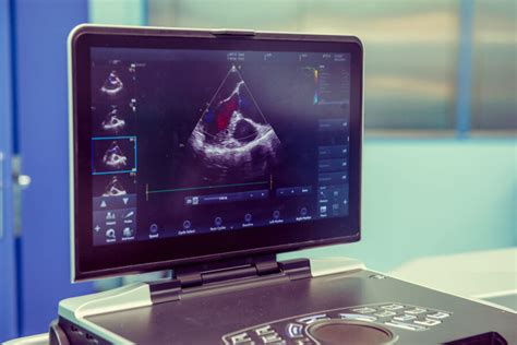 A Patient's Guide to the Echo Procedure - Longmore Clinic