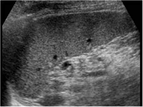 Normal Spleen Ultrasound