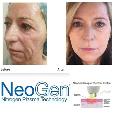 Neogen A Non Invasive Mini Facelift To Restore And Regenerate Your Skin