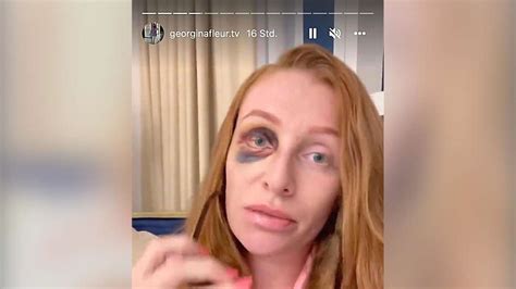 Tv Star Georgina Fleur Zeigt Sich Auf Instagram Mit Blauem Auge Schuld