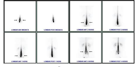 Figure 1 From The Value Of Radionuclide Cisternography In A Case Of