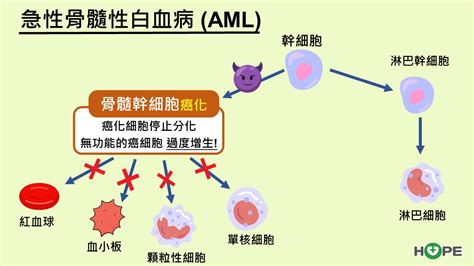 生理處方【名醫開講】兇猛急性骨髓性白血病aml 標靶治療現曙光hope｜癌症希望基金會知識館