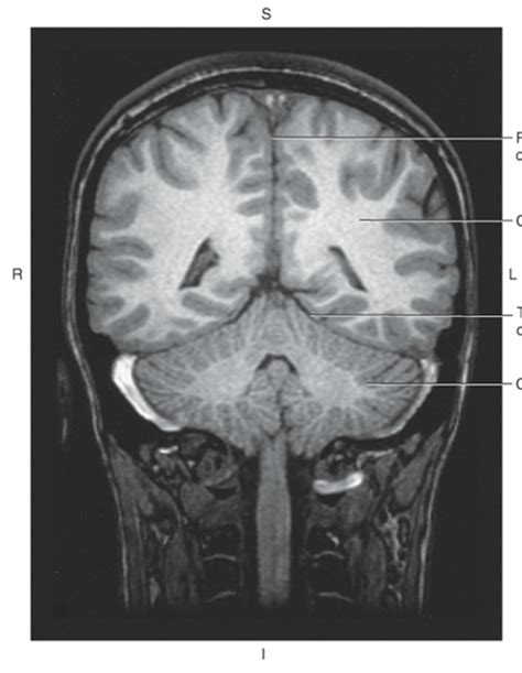 Coronal T1 Weighted MRI Of Falx Cerebra And Tentorium Diagram Quizlet