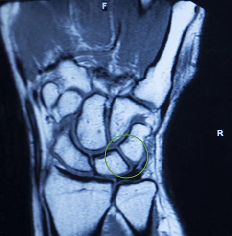 Scapholunate Ligament Injury Pain In The Wrist Ultrasound Guided