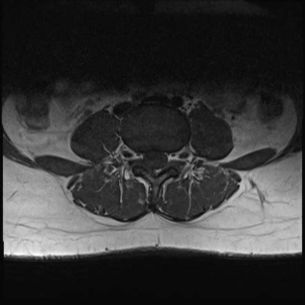 Lumbar Spine Mri Axial