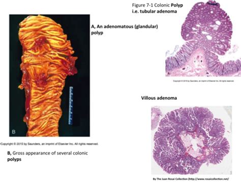 Neoplasia Tcm Flashcards Quizlet