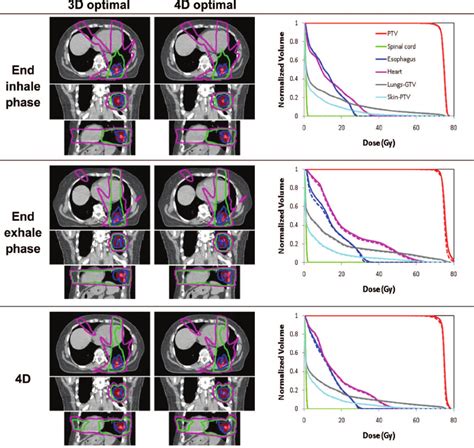 Isodose Distributions For Transverse Coronal And Sagittal Plane Before