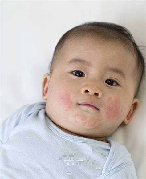 Eczema In Babies What It Is How To Treat It And How It Can Impact