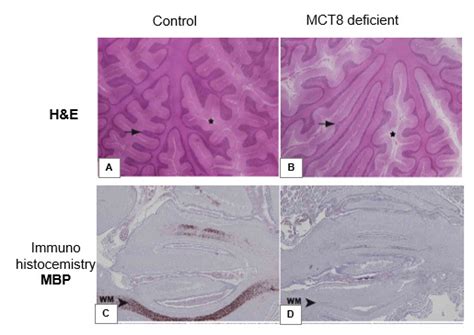 Impaired Sensitivity To Thyroid Hormone Defects Of Transport