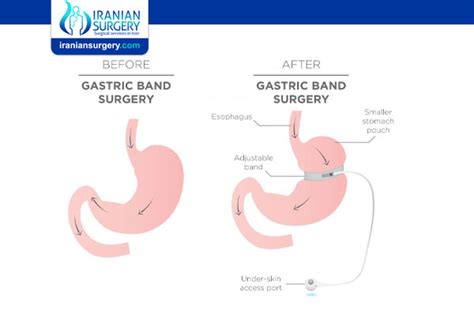 Stomach Banding Pros And Cons Gastric Banding Surgery Pros And Cons