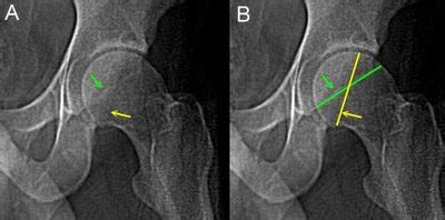 Radiology Cases: Acetabular Retroversion