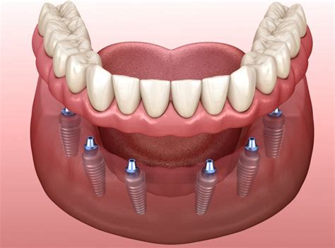 Permanent Dentures Types Pros Cons Costs Chagger Dental