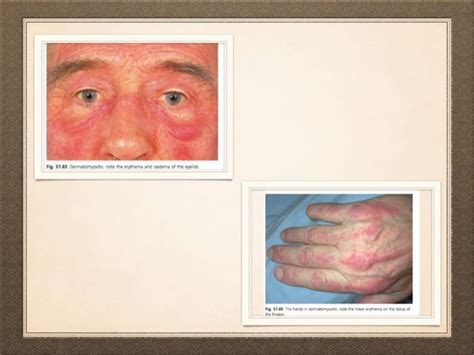 Dermatological Manifestation Of Systemic Diseases PPT