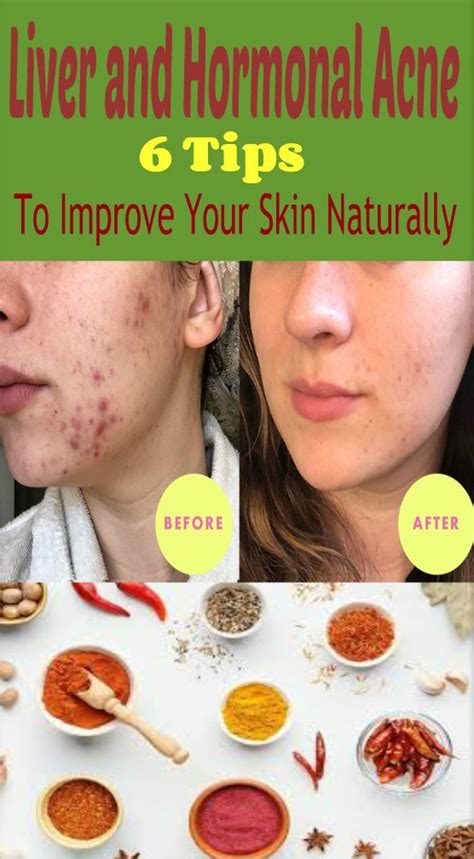 Liver And Hormonal Acne 6 Tips To Improve Your Skin Naturally