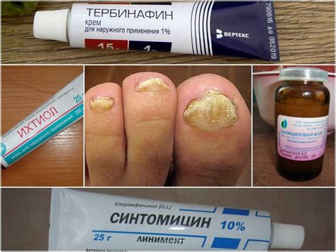 Топ 8 таблетки от грибка ногтей на ногах (15 фото): список лучших, цены ...