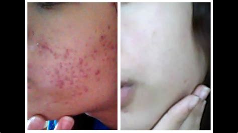 Epiduo Before and After - YouTube