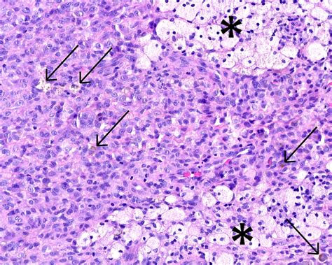 A 37 Year Old Man With A Long Term Knee Mass Jbjs Image Quiz