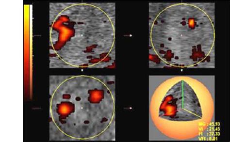 Three Dimensional Power Doppler Placental Vascular Indices A Placental Download Scientific