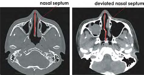 Axial Cross Sectional CT Data For Nasal Septum Left Healthy Nasal