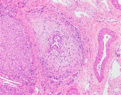 Primary Sclerosing Cholangitis Histology