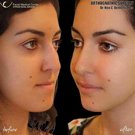 Orthognathic Surgery Before And After Cyprus Facial Surgery