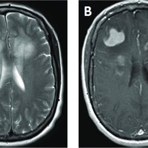 Axial T Weighted A And Axial Contrast Enhanced T Weighted B Mri