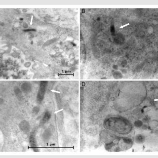 Electron Microscopy Of Endomyocardial Biopsy EMB Specimens In