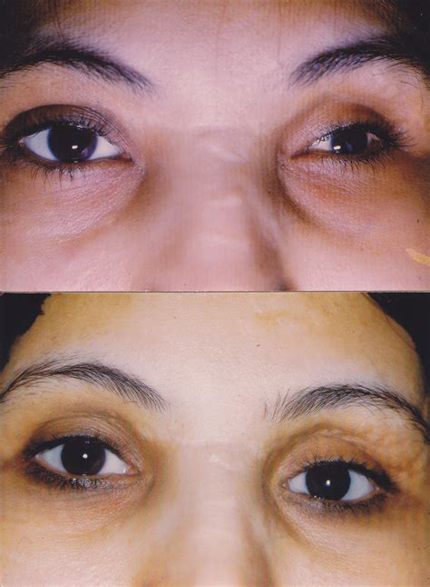 Cosmetic orbital surgery