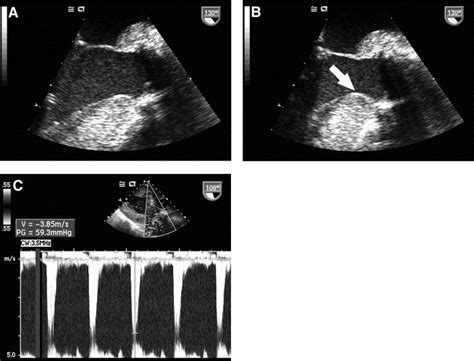 Subvalvular Left Ventricular Outflow Obstruction For Patients