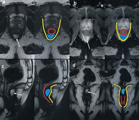 Figure From Magnetic Resonance Imaging Evaluation Of Perianal