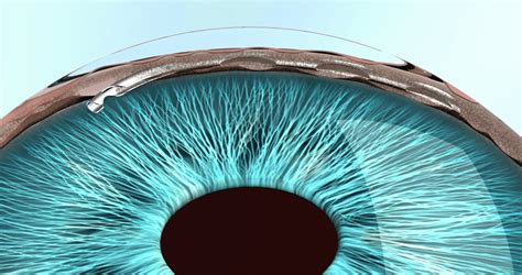 Minimally Invasive Glaucoma Surgery MIGS Glaucoma Australia