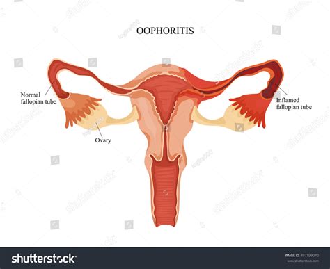 Inflammation Fallopian Tube Oophoritis Stock Illustration 497199070