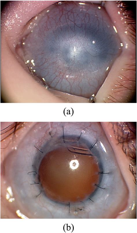 Simple Limbal Epithelial Transplantation Slet In Conjunction With Keratoplasty For Severe