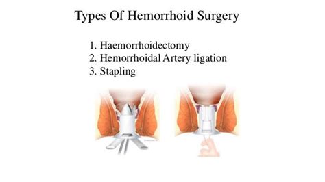 Hemorrhoid Treatment 10 Types Of Hemorrhoid Medical Treatment