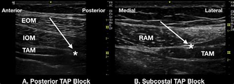 Ultrasound Images Of A Posterior Transversus Abdominis Plane TAP