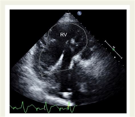 Patient 3 Echocardiogram Showing Severely Dilated Right Ventricle Rv