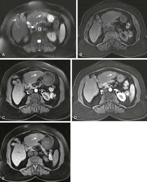 Malignant Tumors Of The Liver Radiology Key