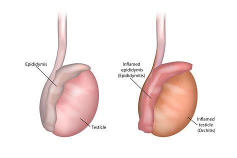 Epididymitis And Orchitis Harvard Health